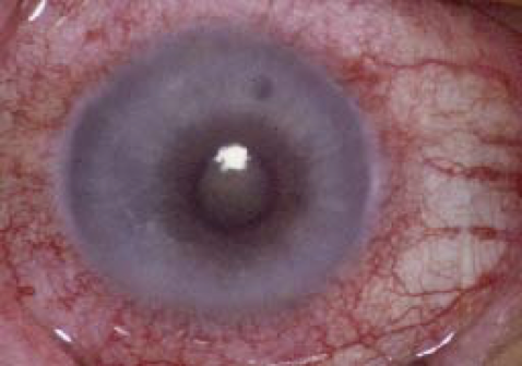 Rougeur oculaire à la phase aiguë d'une uvéite antérieure